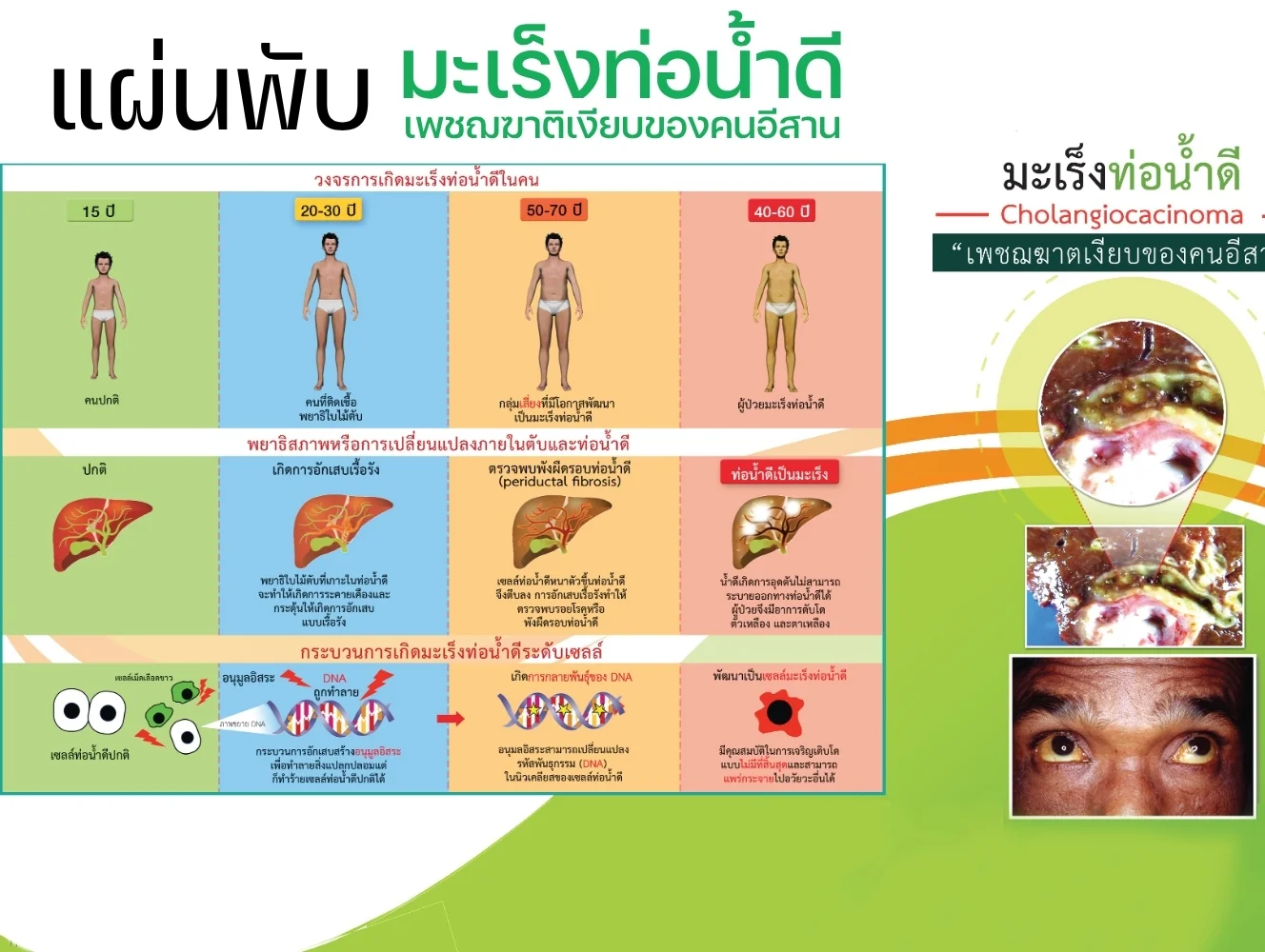 แผ่นพับ "มะเร็งท่อน้ำดี" เพชฌฆาตเงียบของคนอีสาน