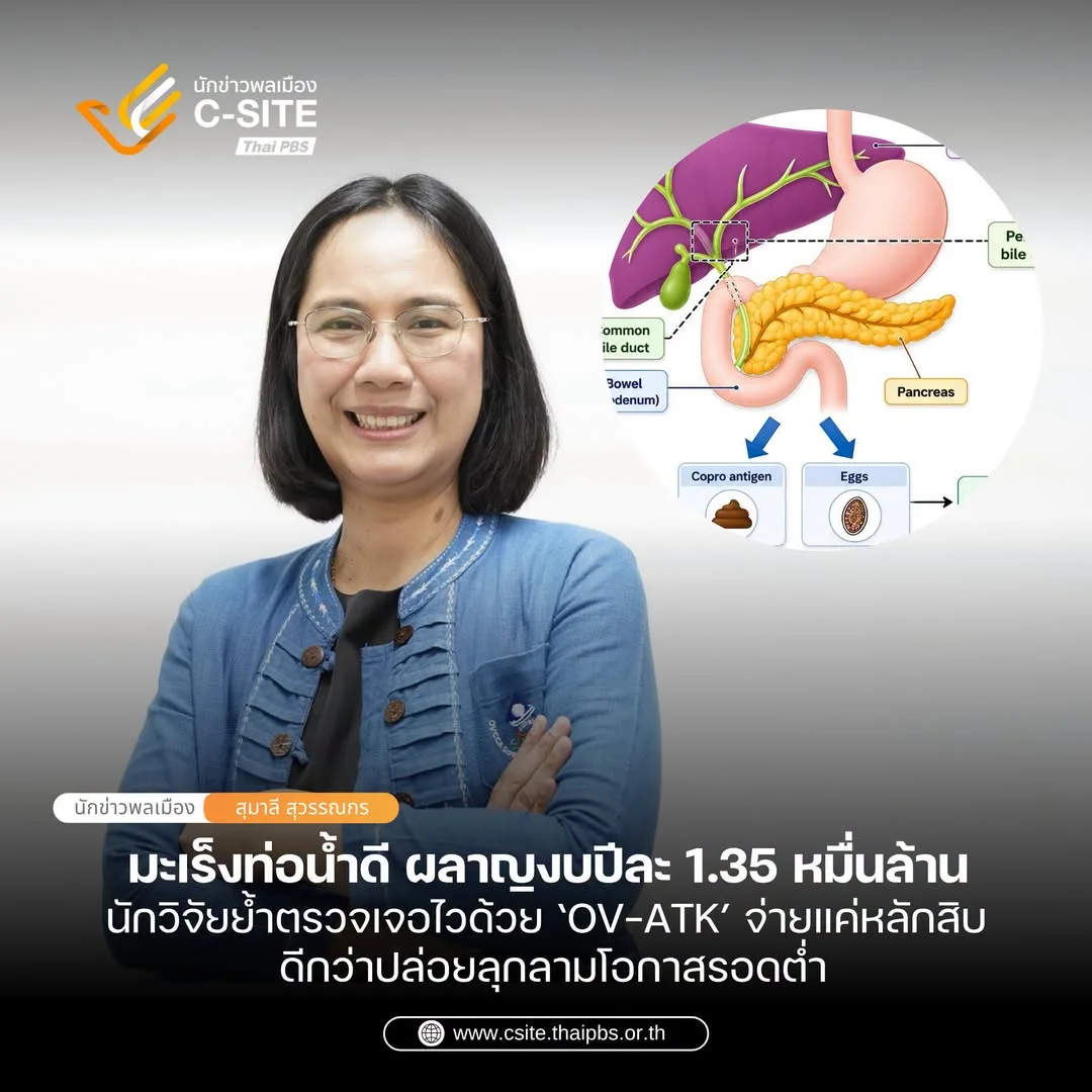 ผู้เชี่ยวชาญเปิดตัวเลขสุดช็อก ไทยสูญงบรักษา "มะเร็งท่อน้ำดี" ปีละกว่า 1.3 หมื่นล้านบาท