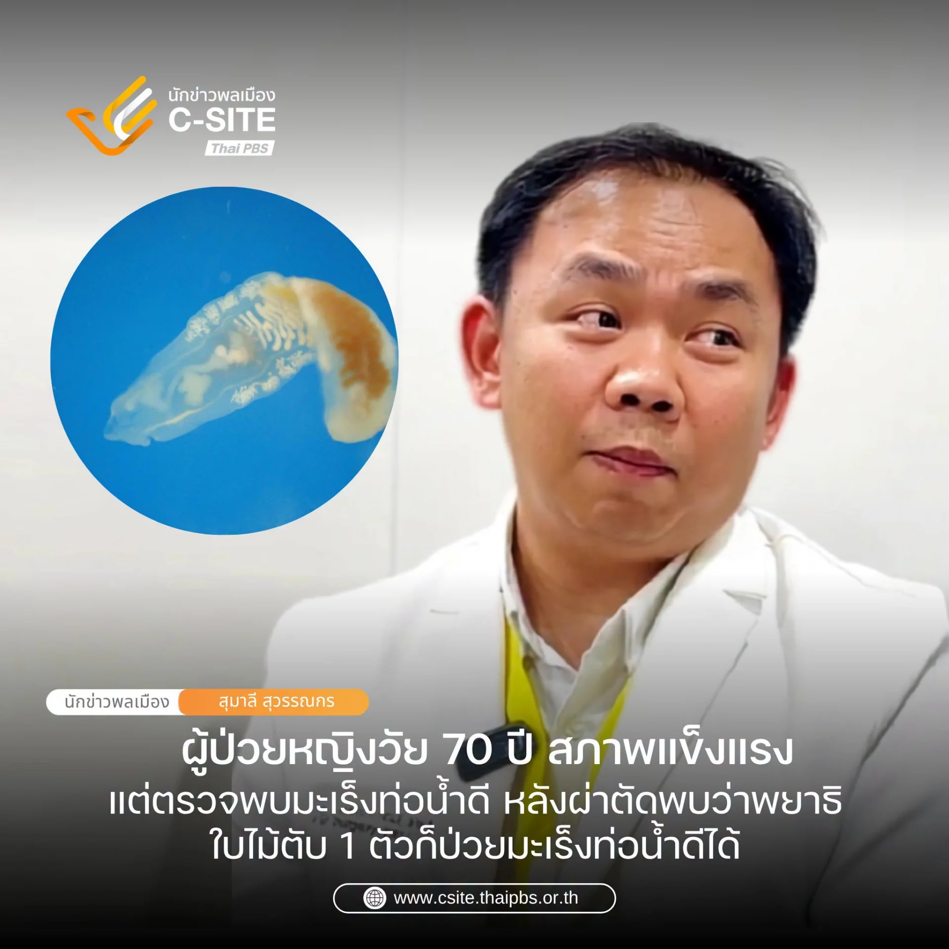 ศัลยแพทย์ผู้เชี่ยวชาญการผ่าตัดตับตับอ่อนและท่อน้ำดีโพสต์ facebook เล่าเคสน่าสนใจ